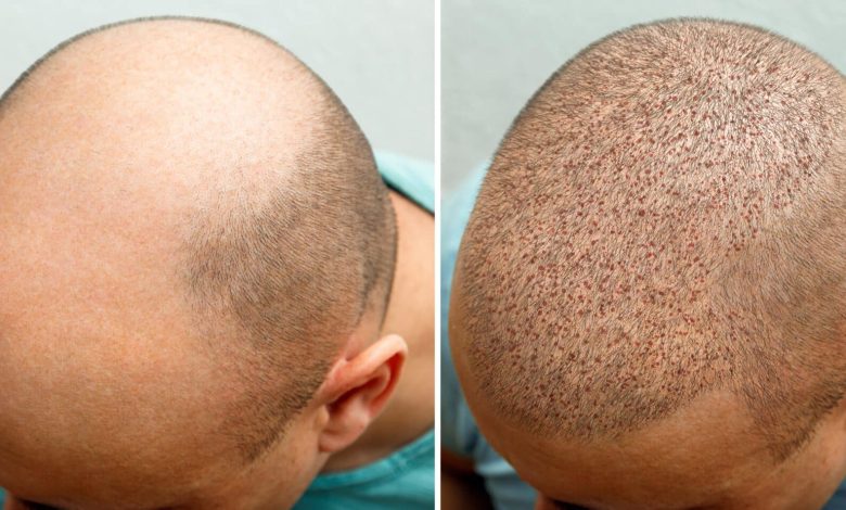 hair transplant turkey