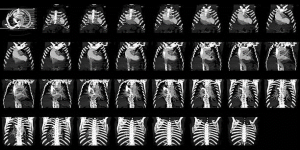 Aortic Aneurysms