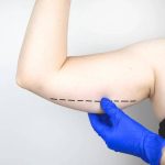 Arm Lift Surgery