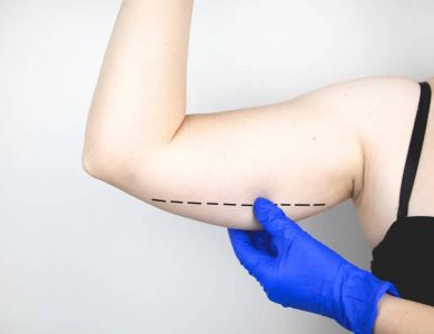 Arm Lift Surgery