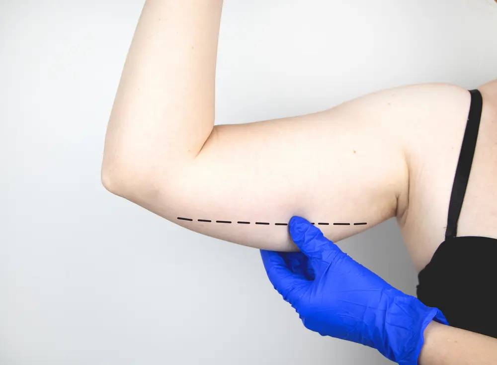 Arm Lift Surgery